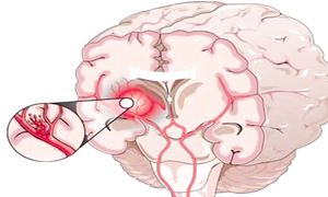 Создано лекарство, которое на 70  повышает шансы на восстановление после инсульт
